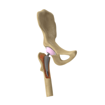Hip joint replacement model
