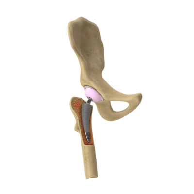 Hip Replacement Surgery, Hip Arthroplasty