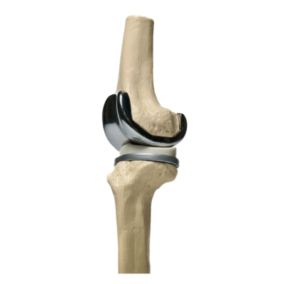 Knee joint replacement model