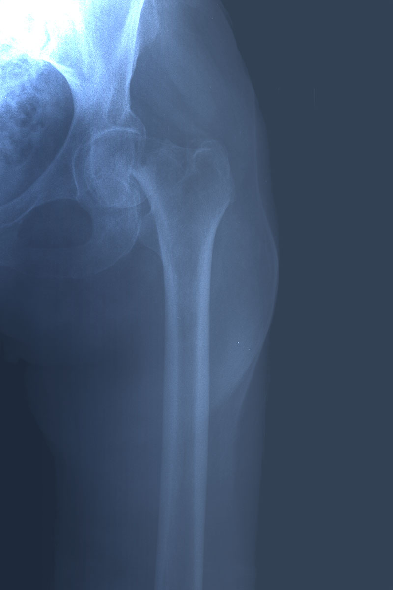 Fracture of the neck of the femur. Candidate patient for prosthesis.