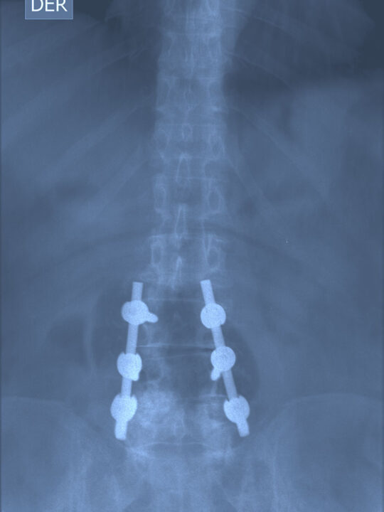 Spine X-ray