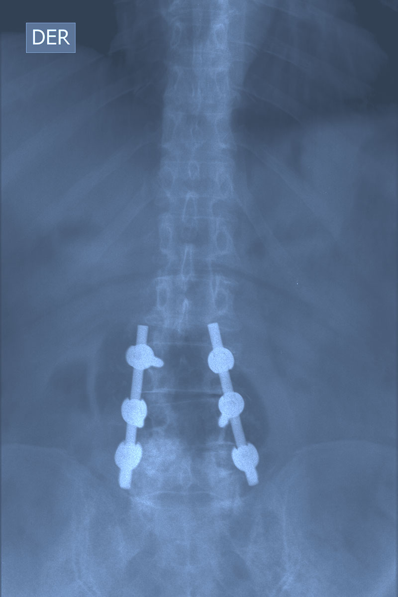 Spine X-ray