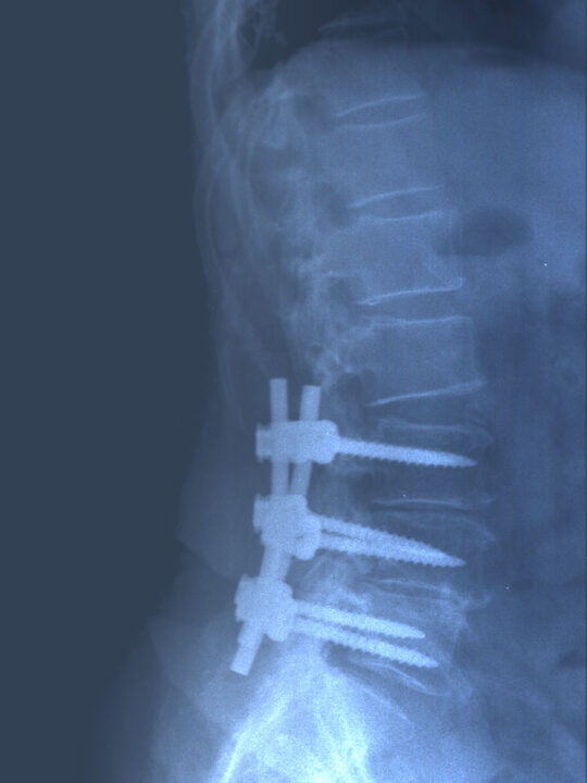 Post surgical X-ray. Instrumentation and lumbar decompression.
