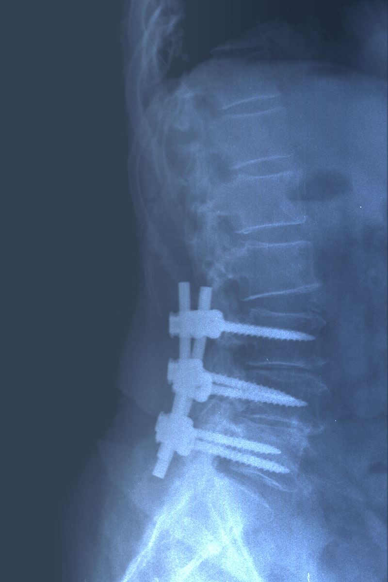 Post surgical X-ray. Instrumentation and lumbar decompression.