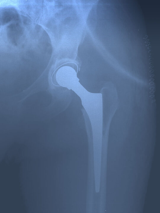 Cemented Hip Prosthesis X-ray. Post surgical day.