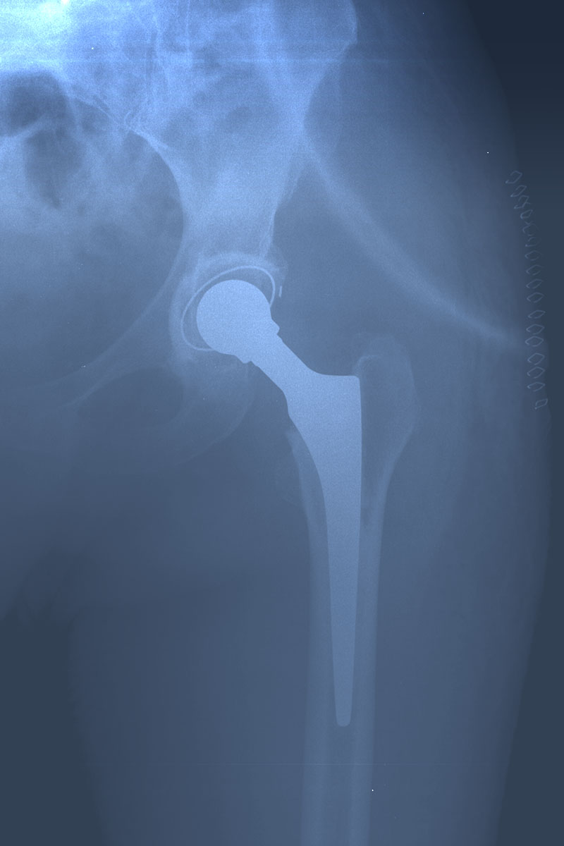 Cemented Hip Prosthesis X-ray. Post surgical day.