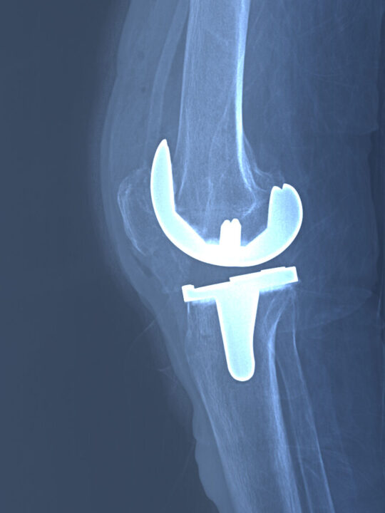 Right knee joint replacement x-ray