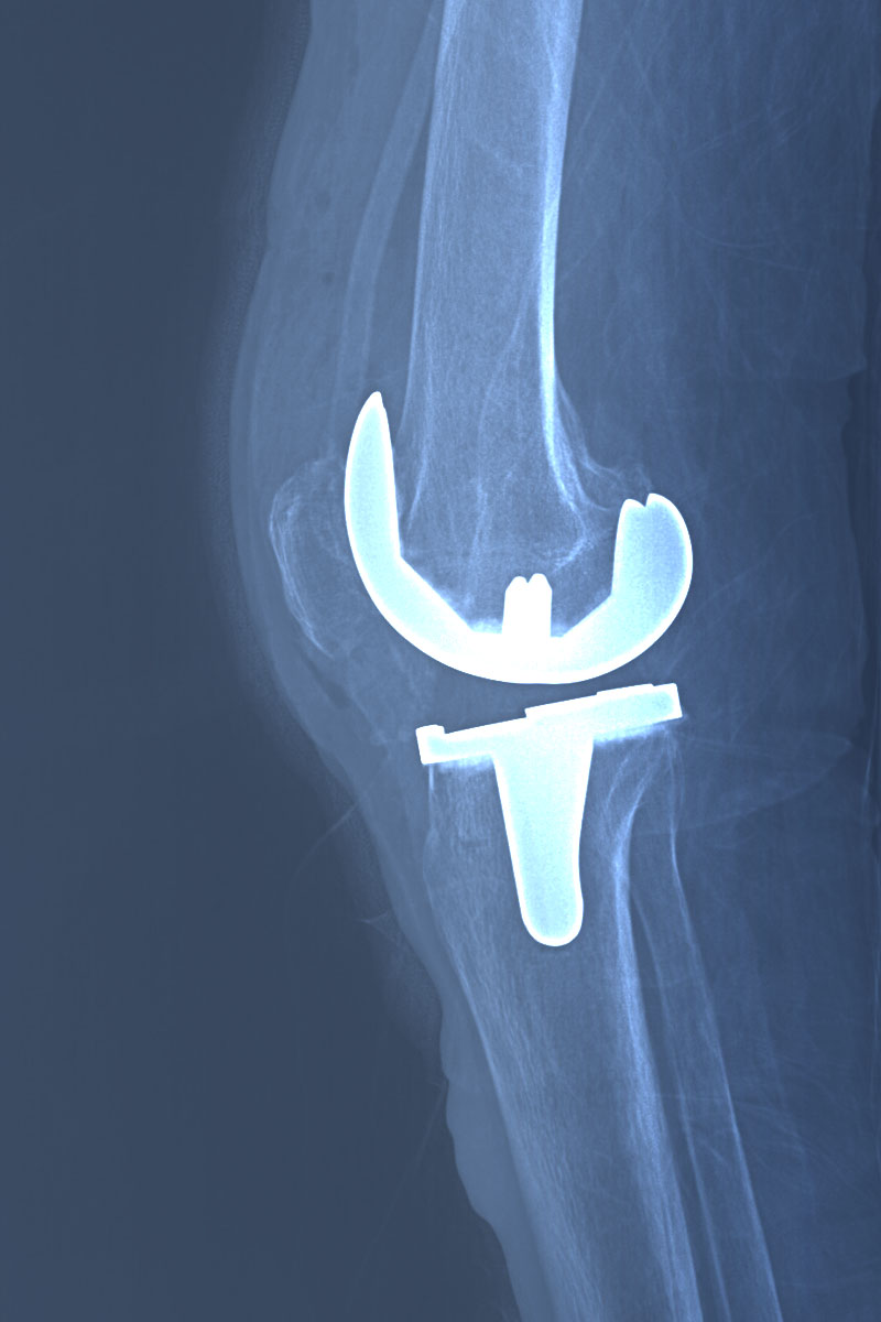 Right knee joint replacement x-ray