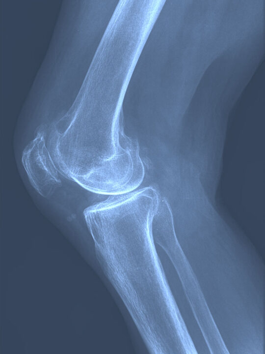 Lateral X-ray of a severely worn knee