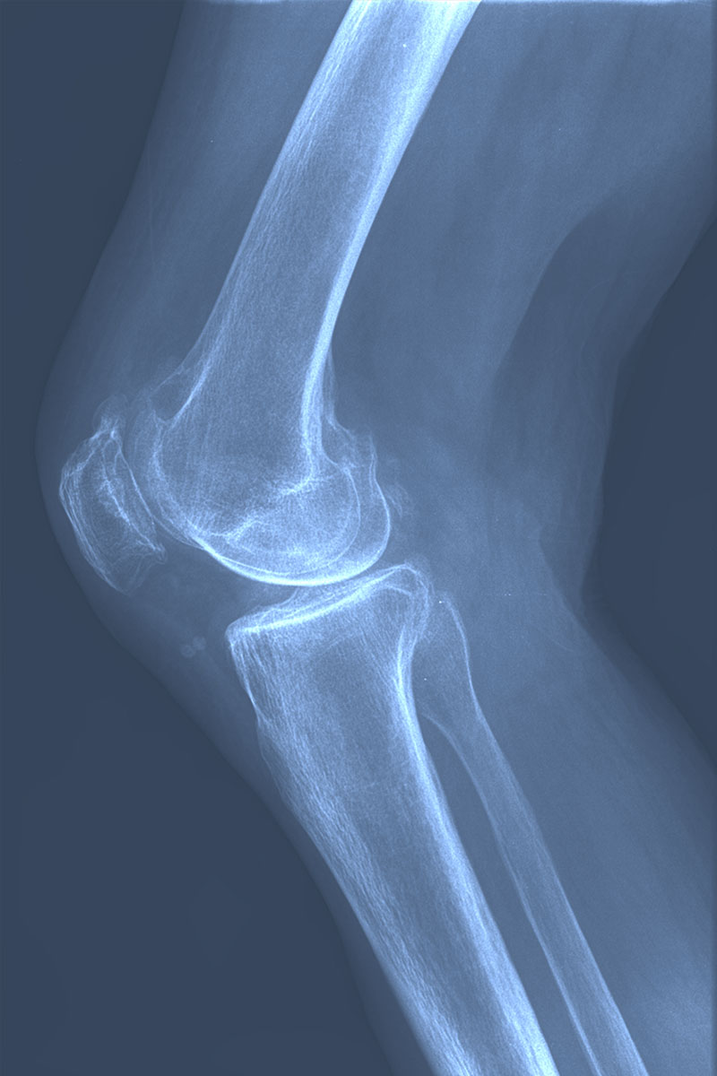 Lateral X-ray of a severely worn knee